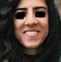 Nose job for bulbous thick skin nose