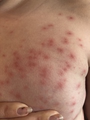 Horrendous rash. Docs stumped. Ideas?