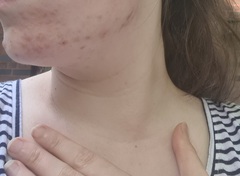 Lymecycline - acne experiences