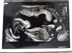 20 week scan