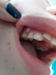 WARNING  - PHOTOS!  Attention dentists  - what is this on DD's gum?