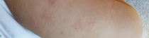 Patchy rash/possibly eczema on my 2 years olds skin