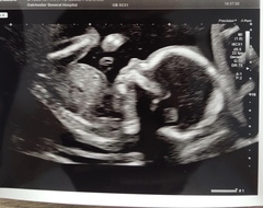 20 week scan