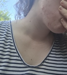 Lymecycline - acne experiences