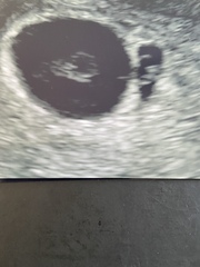 8 weeks scan issues :(