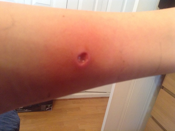 Wtf is this on dp’s leg?! <Gross picture warning>