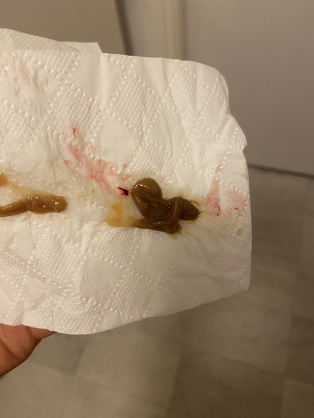 GRAPHIC PIC - passed this during a miscarriage. Is it normal?