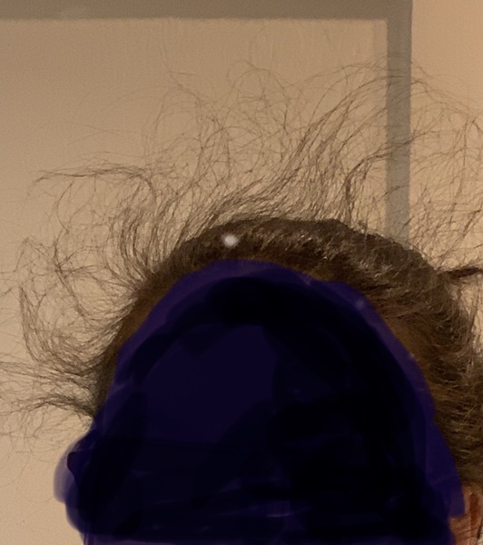 Is there anything I can do about this hairline?