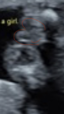 Private scan and gender