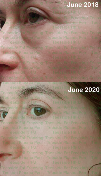 Has anyone been left with scarring after plasma pen/fibroblast?