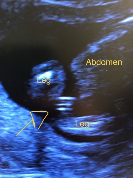 Any sonographers around? (Or any sex scan experts?)
