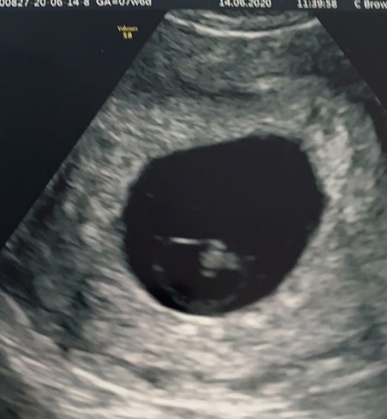 Early scan picture!