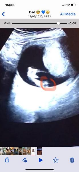 Gender scan ( potty shot )