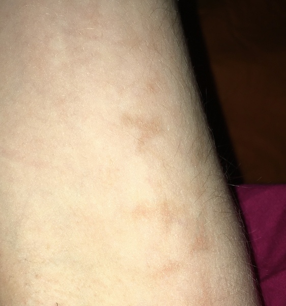 Any experience of Livedo Reticularis?
