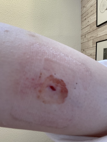 No steristrips after implant removal?