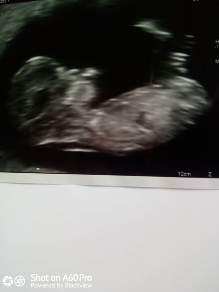Worrying about 12 weeks scan after 1 MC & MMC