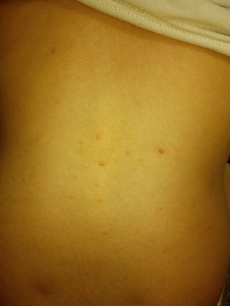 Treatment ideas - molluscum contagiosum?