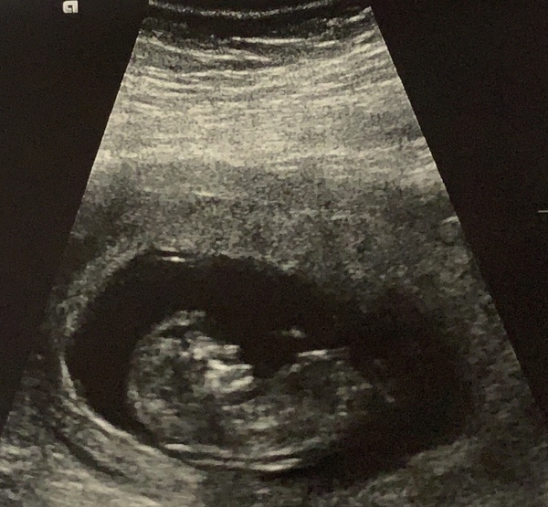 Identical twins gender guess - just for fun!