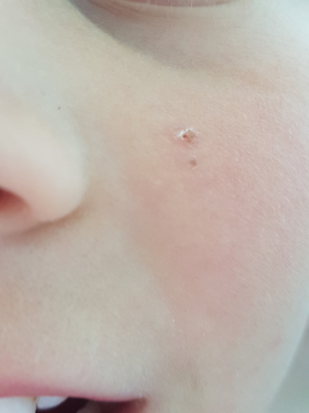 Is this molluscum healing?