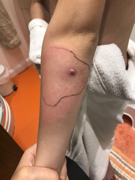Can I have opinions about this infected molluscum on DS’s arm?