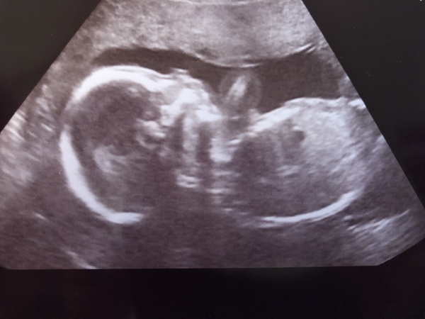 Baby Boy or Baby Girl?