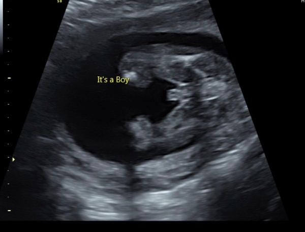 Anyone worried their private gender scan is wrong?