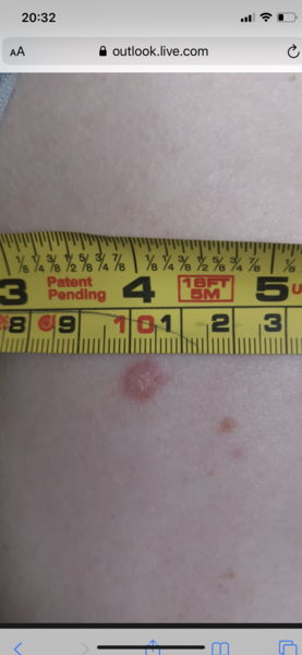 Mole or wart?