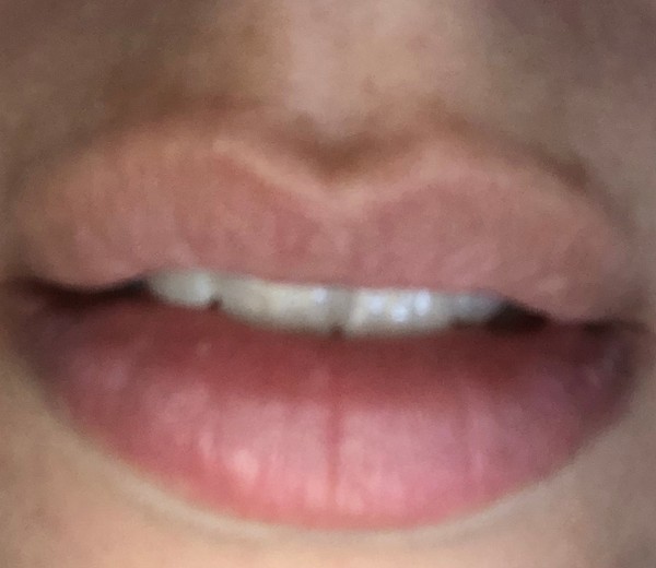 To feel sorry for woman who believe their lip fillers make them more attractive??