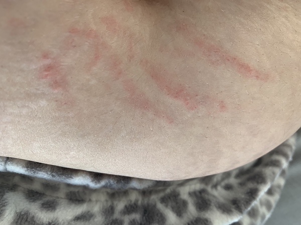 Redness on belly