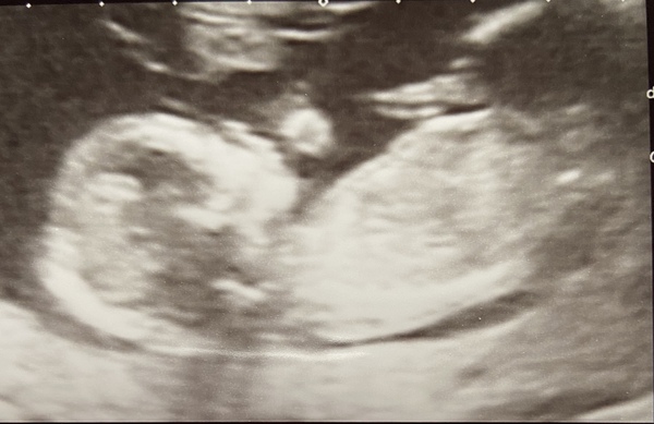 What do you think baby’s sex is?
