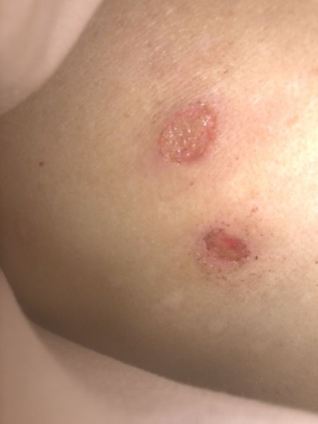 Would you bother a dr over this at the moment - gross photo warning