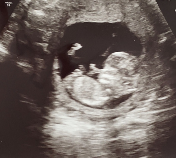 12 week gender guess - just for fun