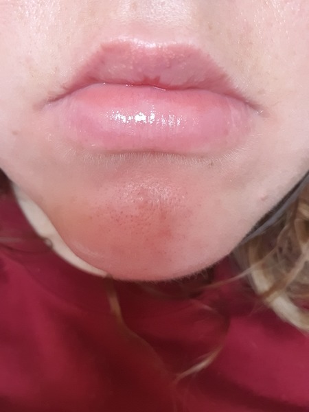 To think you can’t/tell if these lips have fillers? Photo attached