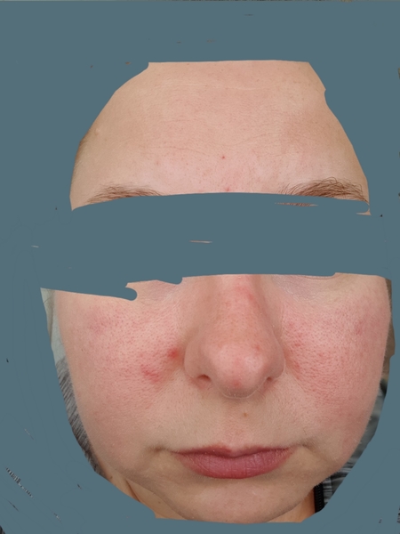 Recommend me a foundation (pic included)