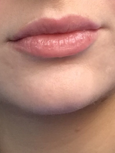 To feel sorry for woman who believe their lip fillers make them more attractive??