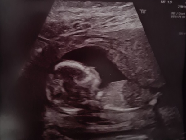 Had my 2nd scan today. I'm 13 weeks and 5 days!