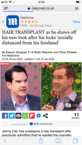 Jimmy Carr Hair Transplant