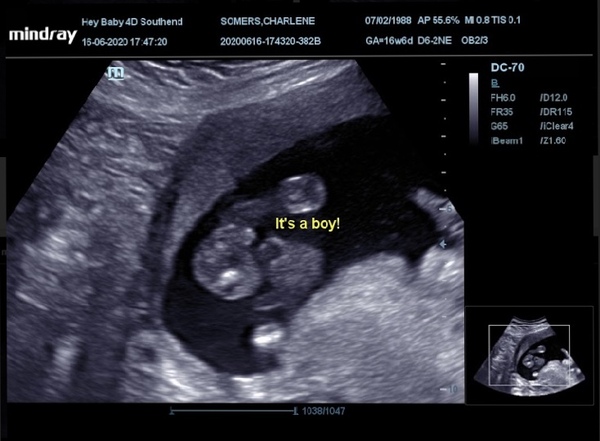 Boy or girl