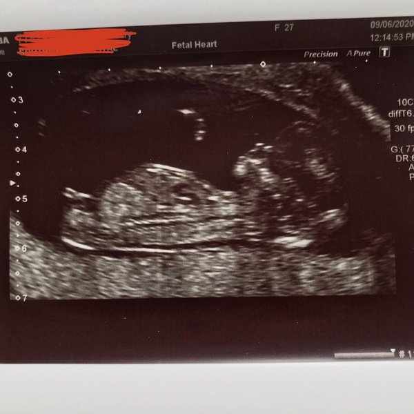 Boy or girl???? What do you think? 💙💗