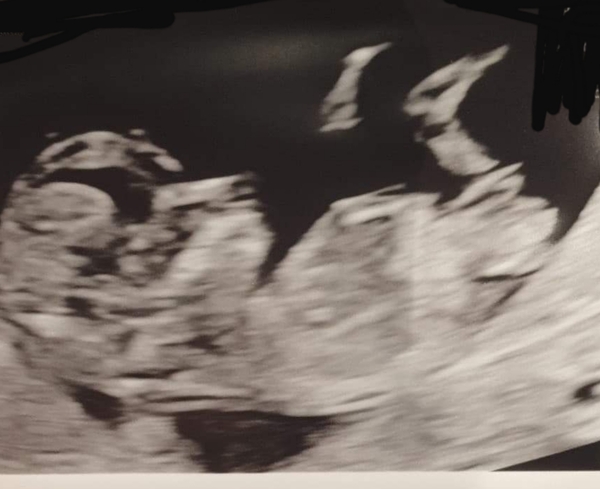 Boy or girl from 12-week scan?