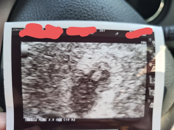 Resting heart rate drop