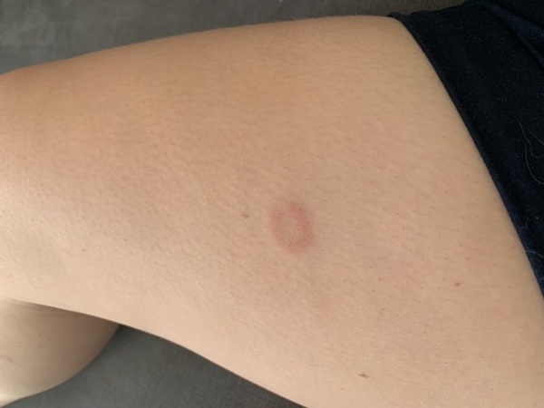 Any idea what this mark on my leg is?