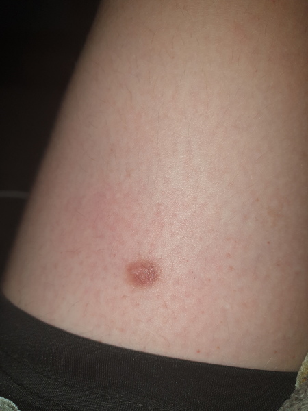 Mole or wart?