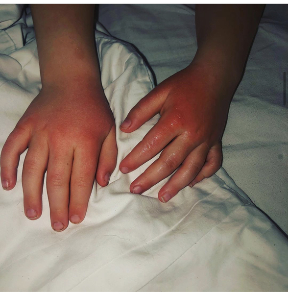 Child's hands so sore from school soap
