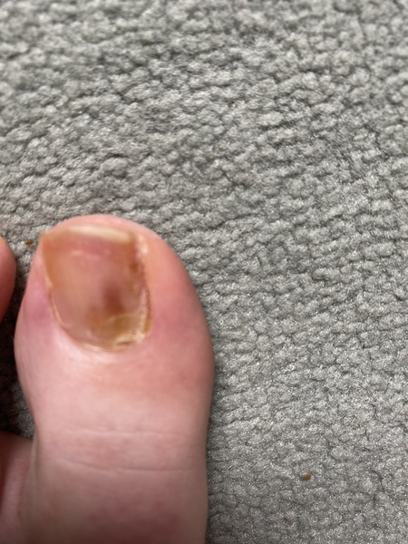 My gross toenail! Diagnose me MN! Foul picture included!