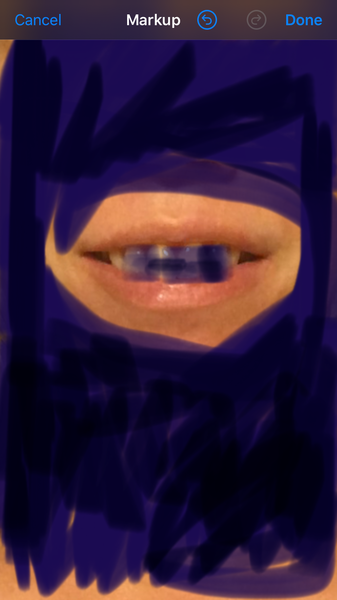 To think you can’t/tell if these lips have fillers? Photo attached