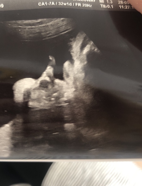 32 week scan tomorrow - low lying placenta
