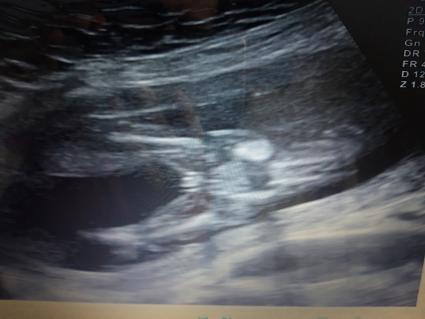 Anyone worried their private gender scan is wrong?