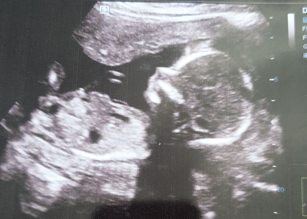 Catching up - TTC after miscarriage part 2