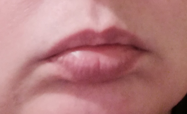 To feel sorry for woman who believe their lip fillers make them more attractive??